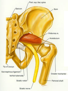 sciatica
