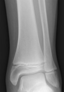 Tib_fib_growth_plates.