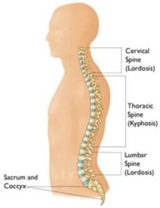 lordosis